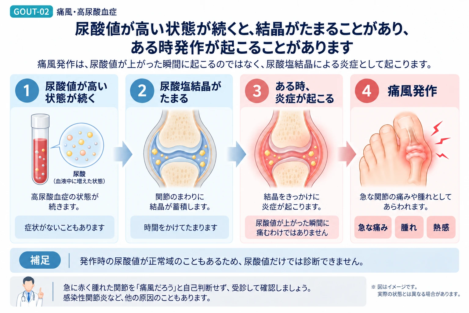 尿酸値が高い状態が続くと尿酸塩結晶がたまることがあり、痛風発作につながることがある流れを説明する図