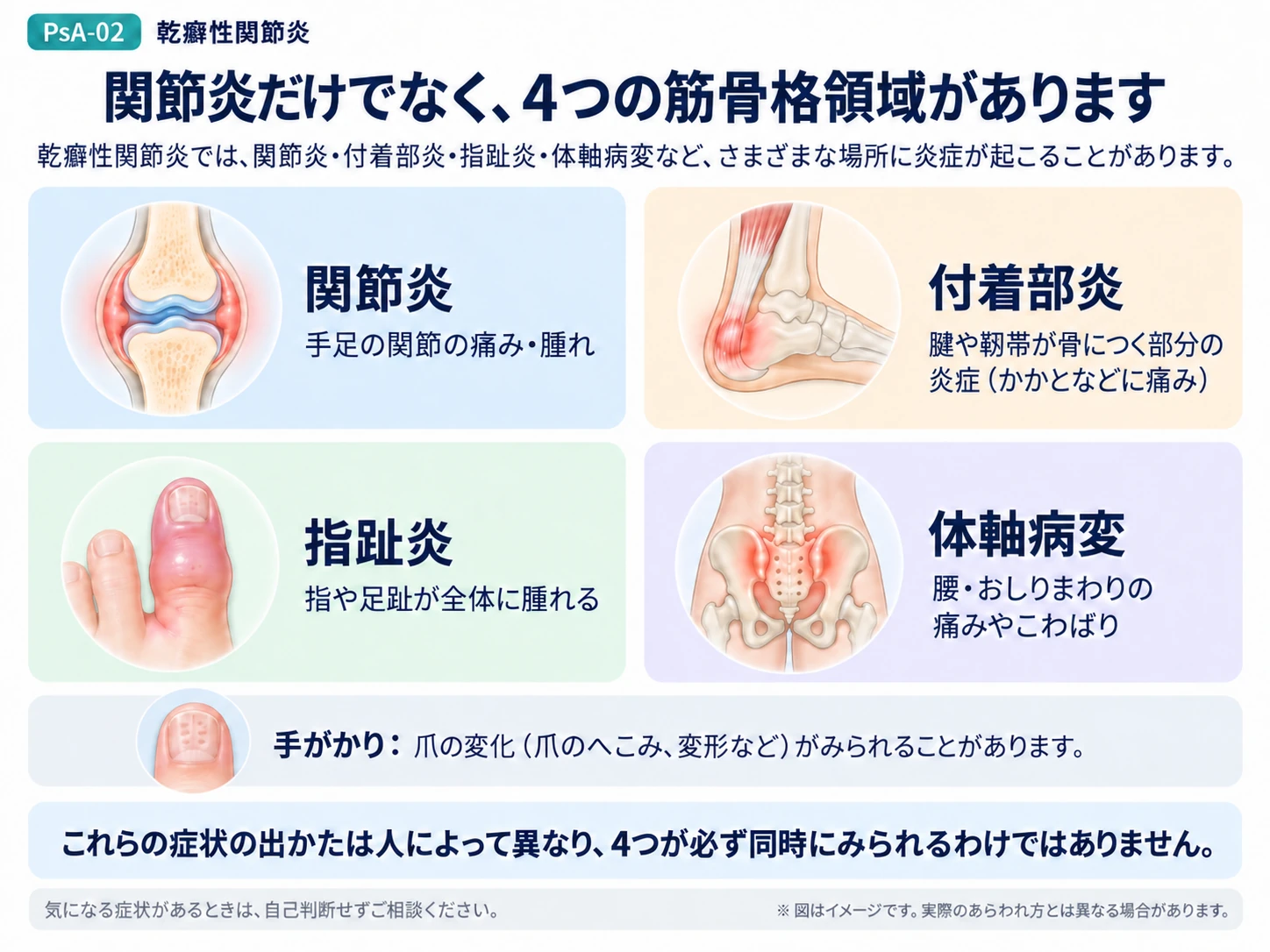乾癬性関節炎でみられる主な症状の現れ方を説明する図
