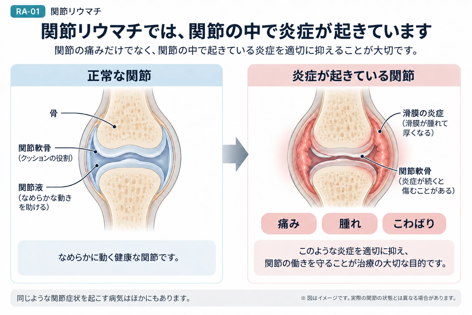 関節リウマチの病気の全体像を説明する図