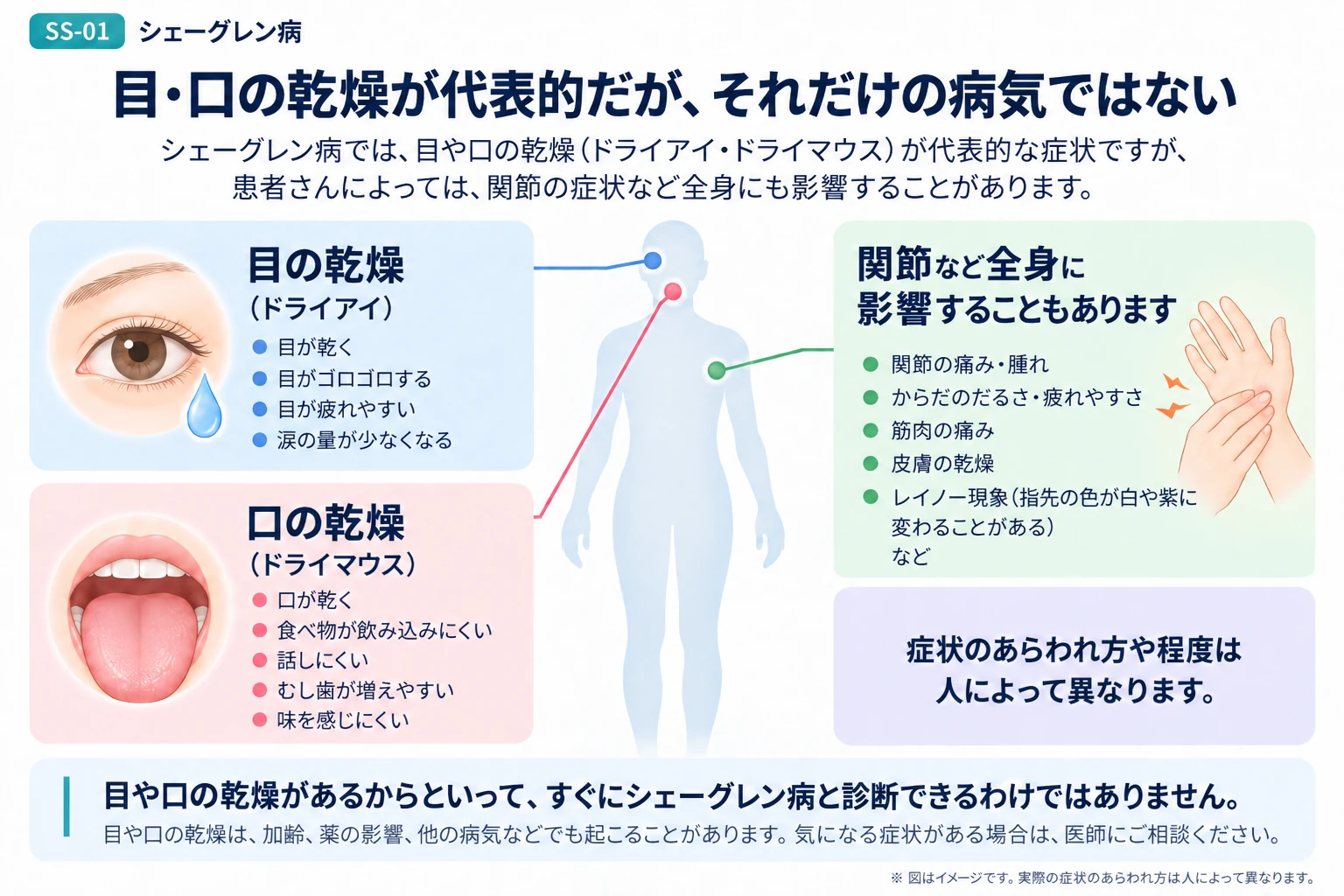 シェーグレン病の乾燥症状と全身に関わる病気の全体像を説明する図